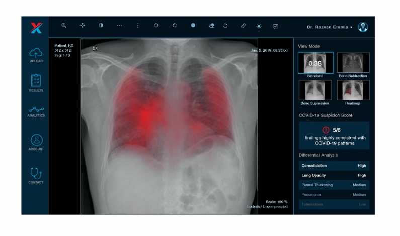radiografii xvision coronavirus covid 19